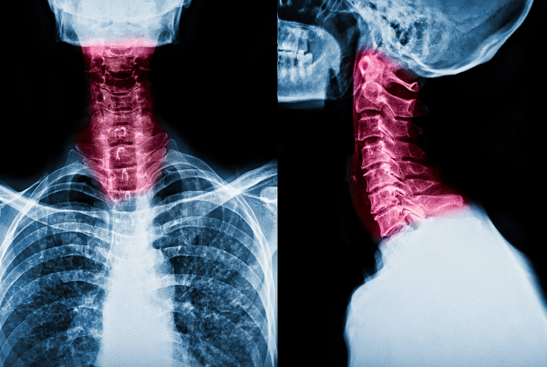 Une radiographie d'un cou